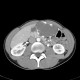 Hemangioma of liver, large: CT - Computed tomography